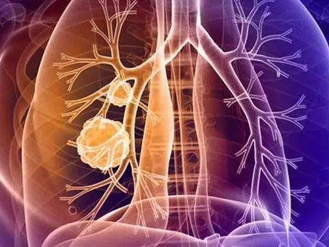 2 vị trí đau bất thường cảnh báo ung thư phổi nhưng dễ bị bỏ qua