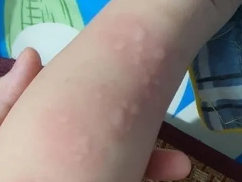 Mẹ run rẩy phát hiện con 15 tháng tuổi nhiễm giun đũa chó và giun lươn