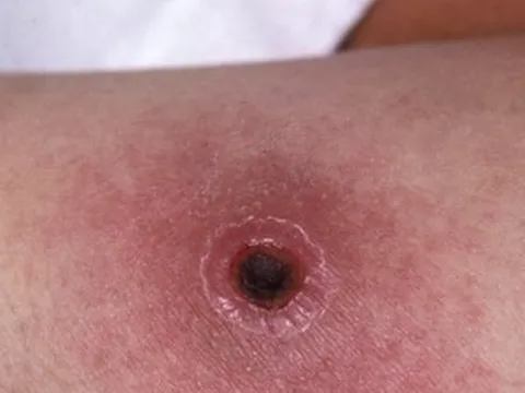 Phát hiện bé gái 2 tuổi mắc bệnh than không rõ nguồn lây