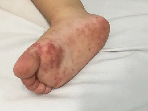 Làm sao sớm nhận biết trẻ mắc tay chân miệng độ nặng?