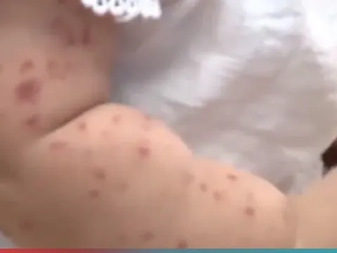 TP. Hồ Chí Minh: Xác định nguyên nhân gây bệnh tay chân miệng nặng ở trẻ em