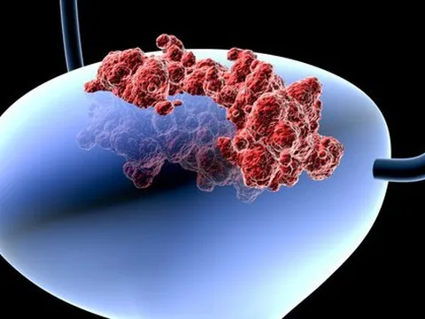 2 triệu chứng phổ biến nhất của ung thư bàng quang, có 1 cũng cần đi khám ngay