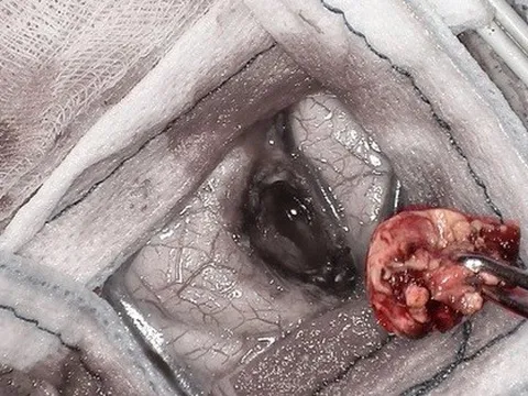 Mổ não bệnh nhân đột quỵ, lấy được khối u hiểm