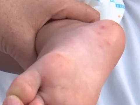 TP Hồ Chí Minh: Bệnh tay chân miệng tăng 133% trong một tuần