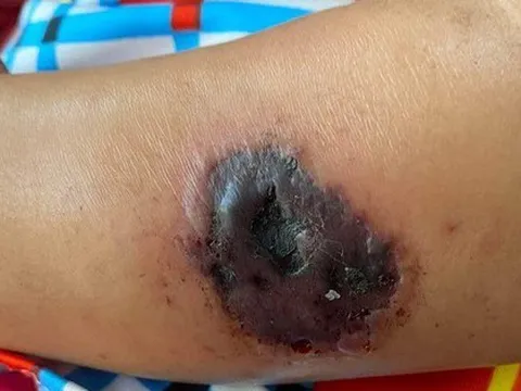 Nguy cơ lây lan bệnh than từ gia súc: Bác sĩ chỉ cách phòng tránh