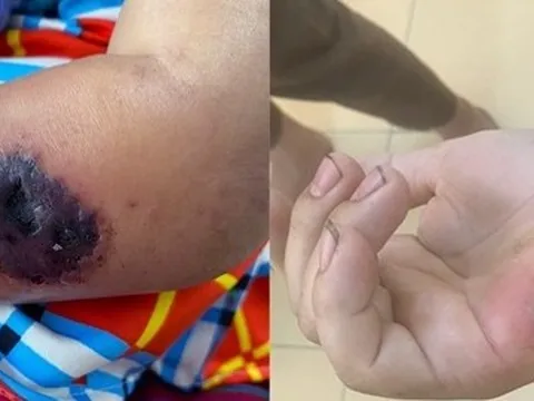 Phòng ngừa bệnh than thế nào?