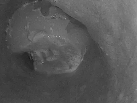 Người đàn ông suýt mất mạng vì cục gân bò 6 cm mắc trong thực quản