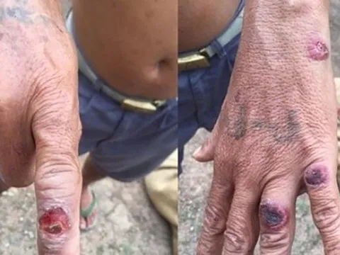 Bệnh than bùng phát mạnh nhất trong 10 năm, nguy cơ lây lan rất cao