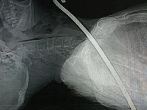 Vấp ngã bị thanh xà beng dài cả mét đâm xuyên cổ