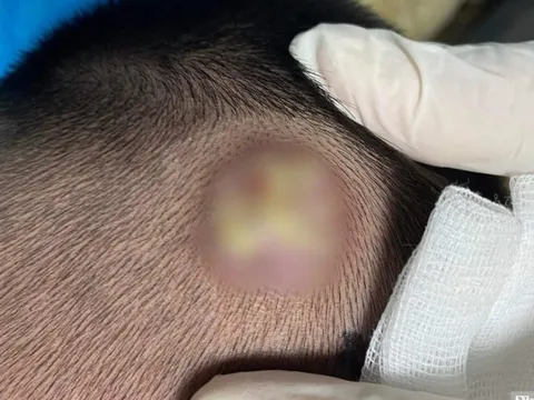 Hai chị em bị bệnh lạ ở vùng da đầu do lây nhiễm từ thú cưng