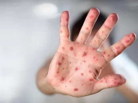 5 dấu hiệu tay chân miệng chuyển nặng