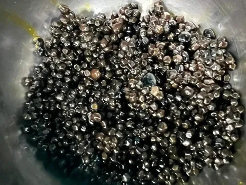 Cụ bà 73 tuổi có hàng nghìn viên sỏi trong túi mật