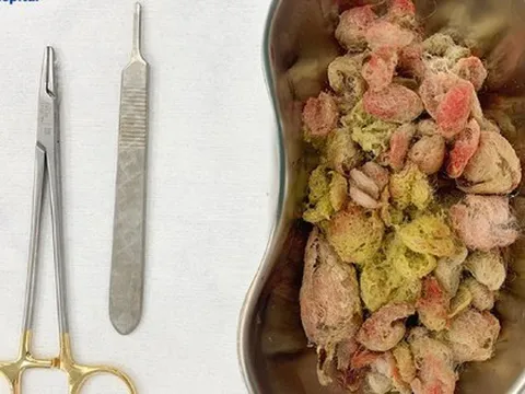 Bé gái nguy kịch vì ăn nửa con gấu bông