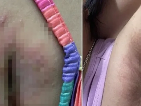 Loại côn trùng có nọc độc gấp 12-15 lần rắn hổ mang khiến bé gái 8 tuổi nhập viện