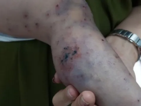 Phân bổ 6.000 chai thuốc đặc trị tay chân miệng cho bệnh viện