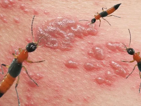 Loại côn trùng nọc độc hơn rắn hổ mang cắn khiến 2 người sưng vù mắt