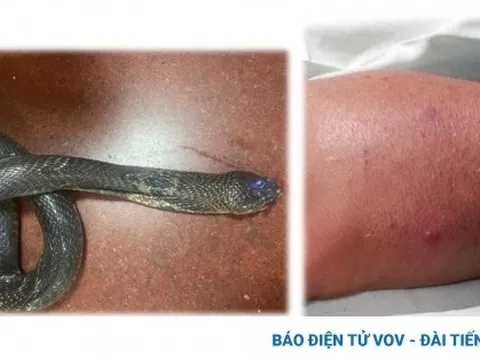 Truyền 70 lọ huyết thanh cấp cứu liên tiếp cho 3 bệnh nhân bị rắn cắn