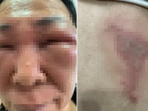 Bóp chết côn trùng rồi quẹt tay lên mặt, hai vợ chồng không mở nổi mắt