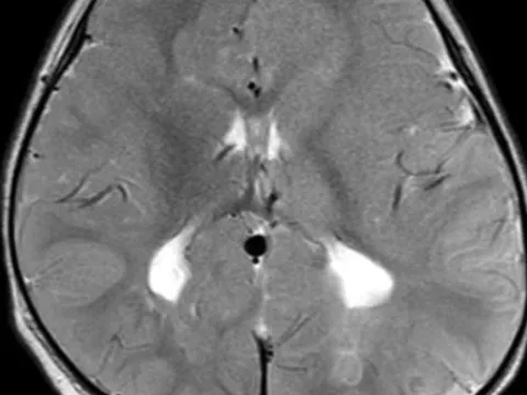 TP Hồ Chí Minh: Phát hiện hai trường hợp bệnh nhi nguy kịch do mắc bệnh não cấp hiếm gặp