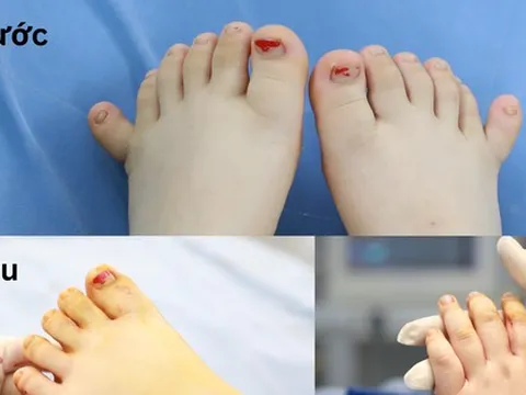 Em bé có 12 ngón tay, 12 ngón chân cực kỳ hiếm gặp