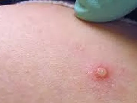 Trung Quốc phát hiện thêm nhiều ca bệnh đậu mùa khỉ