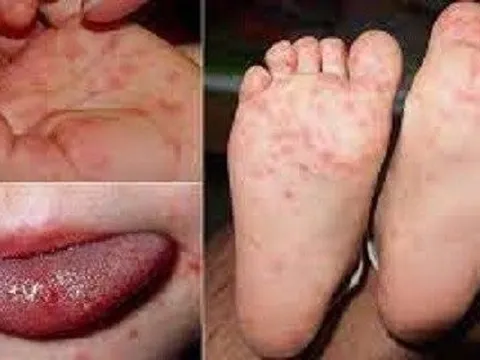 Bà Rịa - Vũng Tàu ghi nhận ca tử vong đầu tiên do bệnh tay chân miệng