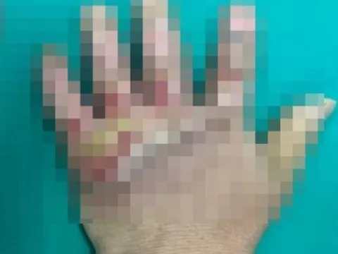Nhiễm trùng nặng bàn tay do chữa bỏng bằng thuốc 'lạ'