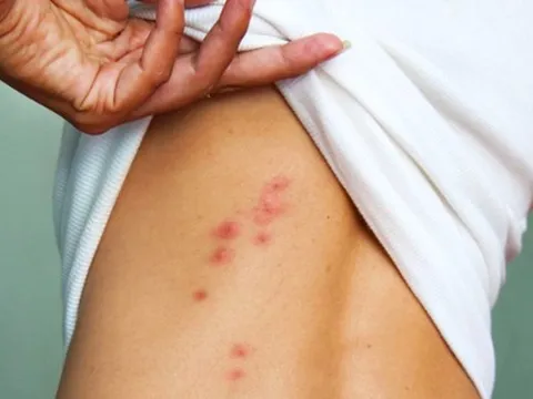 Nữ dược sĩ 28 tuổi tử vong sau khi mắc thuỷ đậu không rõ nguồn lây