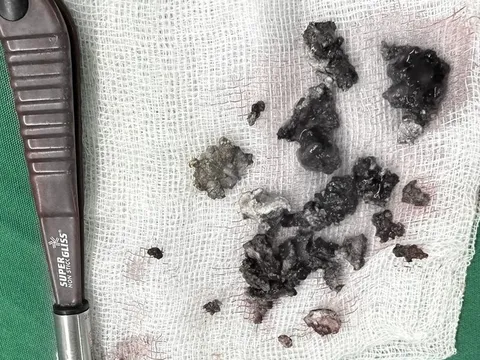 Lấy khối sỏi nằm trong hốc mũi bệnh nhân gần 30 năm