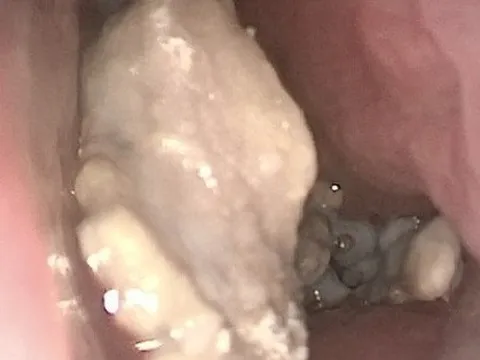 Hơn 30 năm bị dị vật hóa đá bít mũi mà không biết