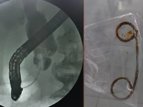 Nhiễm trùng nặng vì quên stent trong đường mật 2 năm