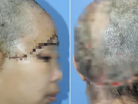 Người phụ nữ "bay" mất toàn bộ da đầu trong lúc phụ chồng khoan giếng