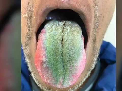 Kỳ lạ người đàn ông có lông mọc dày và xanh lè trên lưỡi