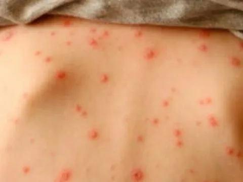 Bác sĩ Bệnh viện Bạch Mai cảnh báo nhiều trường hợp mắc thủy đậu tử vong