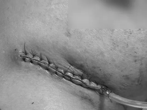 Biến dạng vì nâng ngực theo quảng cáo trên mạng xã hội