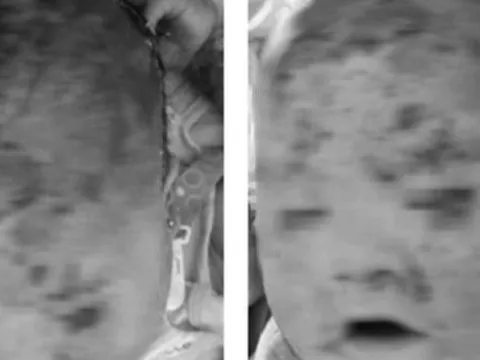 Bé trai bong tróc toàn bộ da mặt và đầu sau tắm lá