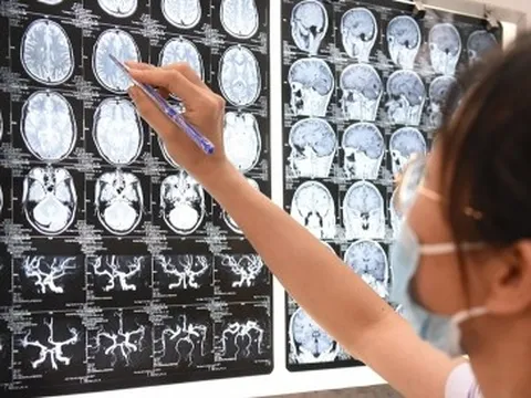 Triệu chứng tương đồng giữa u não và nhiễm sán lợn trên não