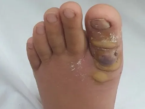 Tiện tay nhổ sợi lông chân, thiếu nữ phải nằm viện cả tuần