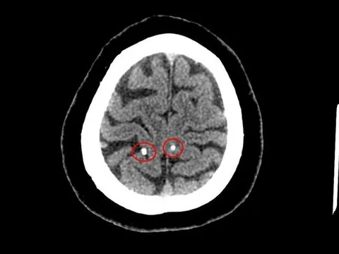 Sán làm tổ trong não vì thói quen ăn đồ sống