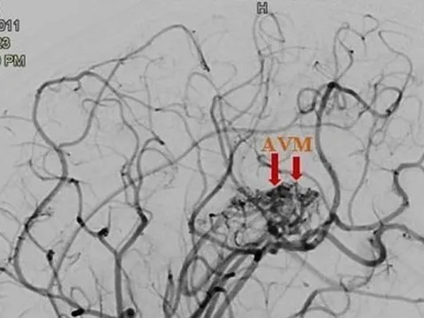 Bé gái 12 tuổi bị đột quỵ