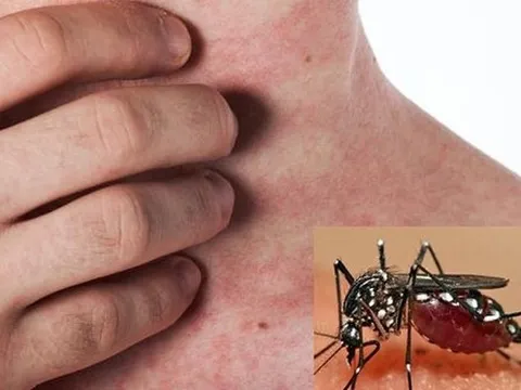 4 vấn đề sức khỏe bạn có thể gặp sau khi khỏi sốt xuất huyết