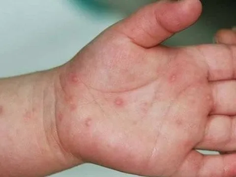Bình Thuận: Một ca tử vong do bệnh tay chân miệng