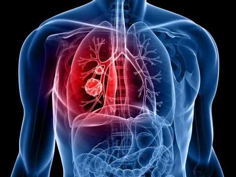 Nghiên cứu mới tiết lộ loại thực phẩm nhiều người ăn hàng ngày có thể giúp ngăn ngừa ung thư phổi