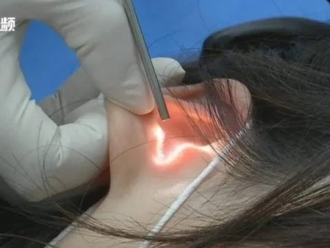 Cô gái bất ngờ bị thủng một bên màng nhĩ sau nụ hôn của bạn trai