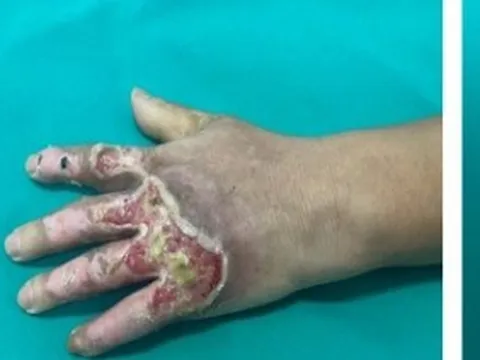 Đắp thuốc chữa bỏng không rõ nguồn gốc nên bị nhiễm trùng bàn tay