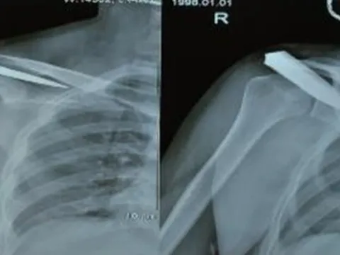 Mâu thuẫn gia đình, nam thanh niên bị đâm gãy dao