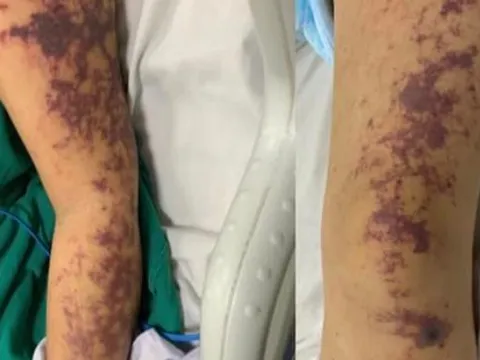 Người phụ nữ nguy kịch sau khi ăn món lòng lợn cùng gia đình