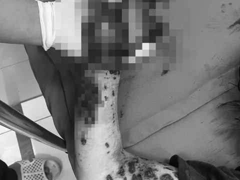 Vừa sạc vừa dùng, người phụ nữ bị điện thoại nổ nát bàn tay