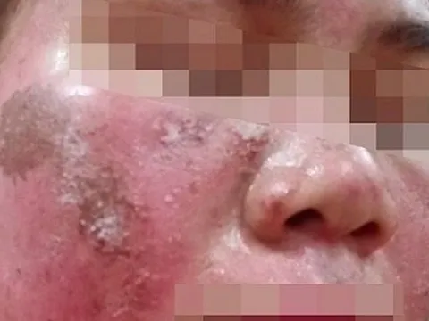 Cô gái trẻ da bong tróc như rắn lột da sau khi dùng kem 'peel'