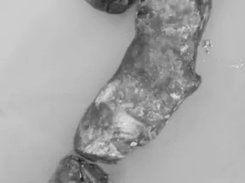 Viên sỏi “hình cây” trong đường mật người đàn ông